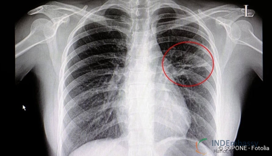 viêm phổi điển hình