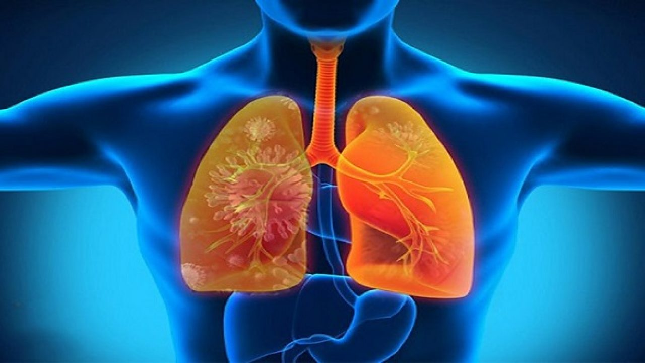 viêm phổi hít