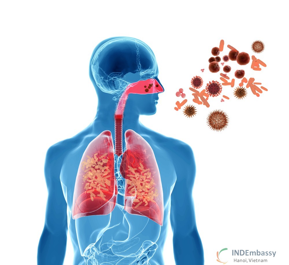 viêm phổi hoại tử là gì