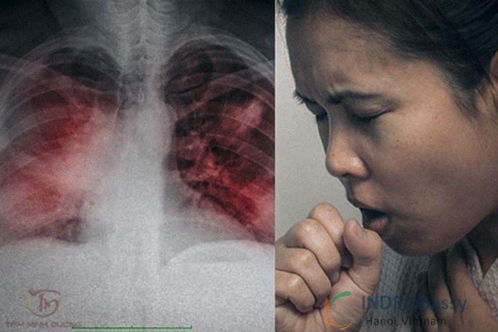 viêm phổi kẽ