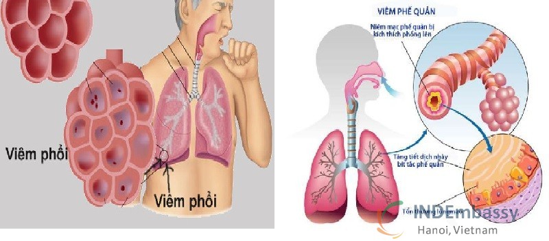 Sự khác nhau giữa viêm phổi và viêm phế quản