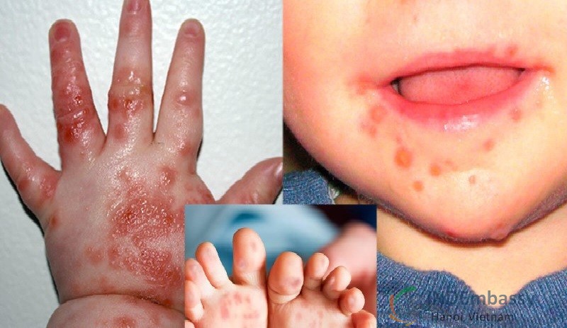 Trẻ bị đau họng khó nuốt triệu chứng bệnh gì