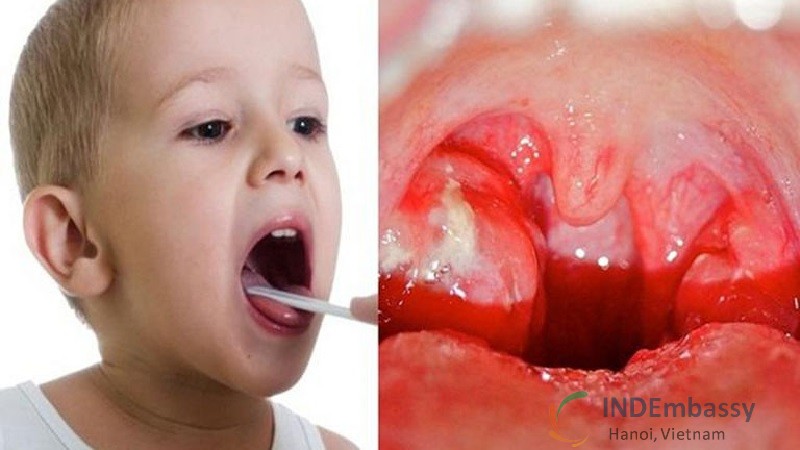Trẻ bị đau họng khó nuốt