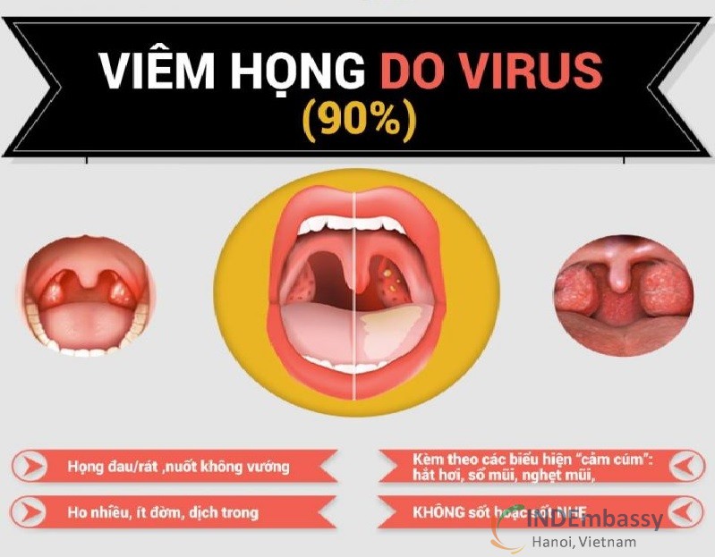 Viêm họng do virus