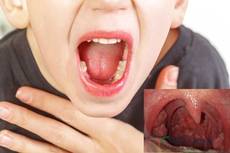 Viêm họng hạt ở trẻ em