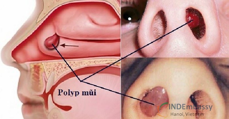 Polyp mũi nguyên nhân gây viêm mũi chảy máu