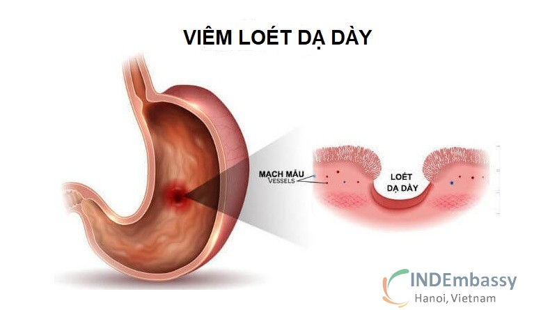 Viêm loét dạ dày